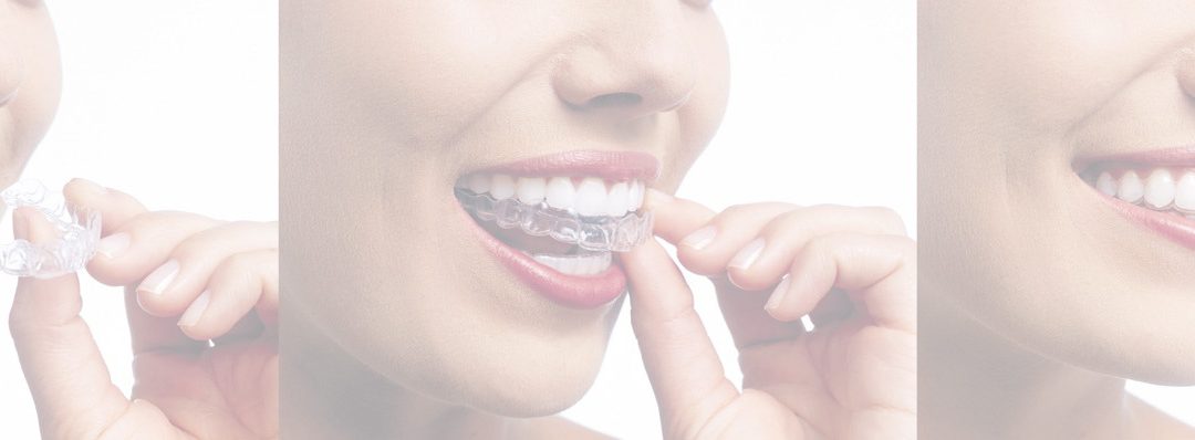 Can You Have an Allergic Reaction to Invisalign?