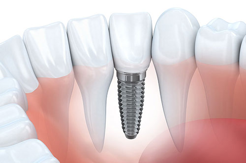 Fraser Street Dentist Dental Implant