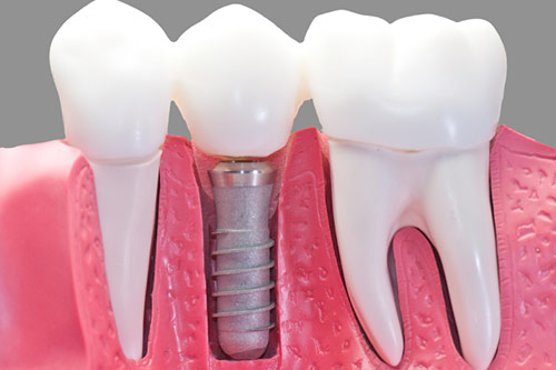 Dentist Vancouver dental implants vs bridges vancouver