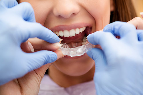 Your Invisalign South Vancouver Provider