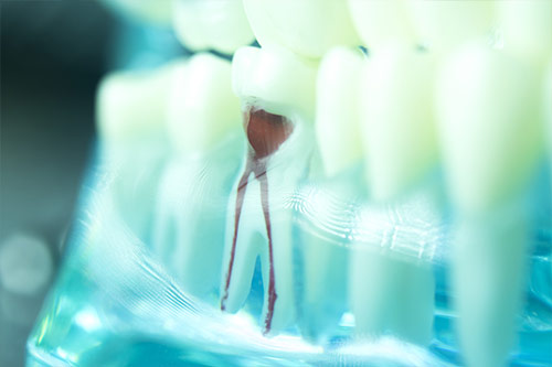Root canal treatment vancouver